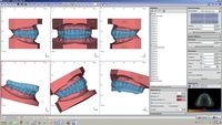 OnyxCeph³™ Módulo Bite Splint 3D